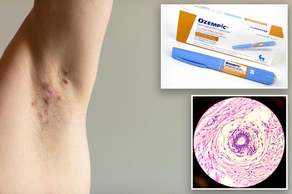 Ozempic may improve skin condition hidradenitis suppurativa: study